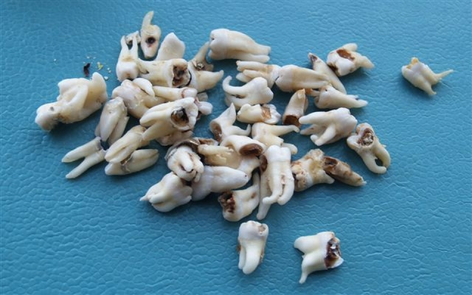 Стоматолог в Любашевке Одесской области собирает коллекцию аномальных зубов (фото)