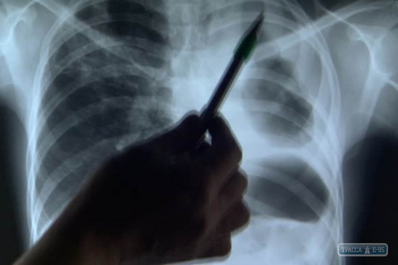 Заболеваемость туберкулезом в Одессе снизилась впервые за несколько лет